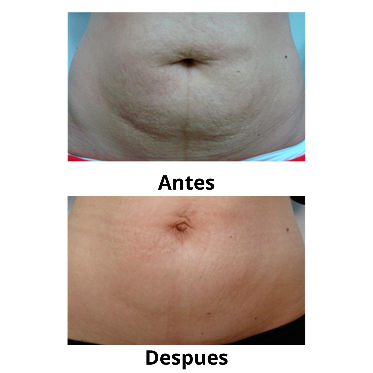Crema Corporal para Masajes Anti Estrías Flower Secret